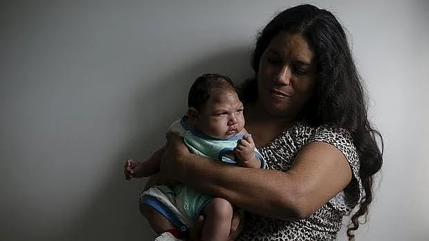 Bebé con microcefalia por el virus del Zika