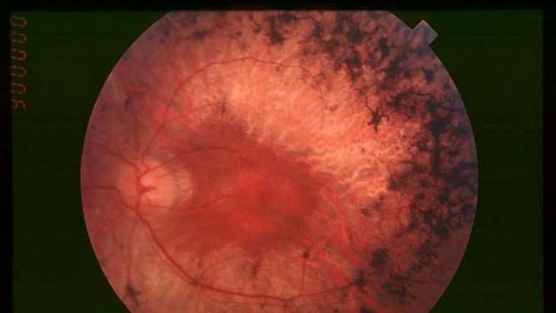 Fondo de ojo de un paciente con retinosis pigmentaria