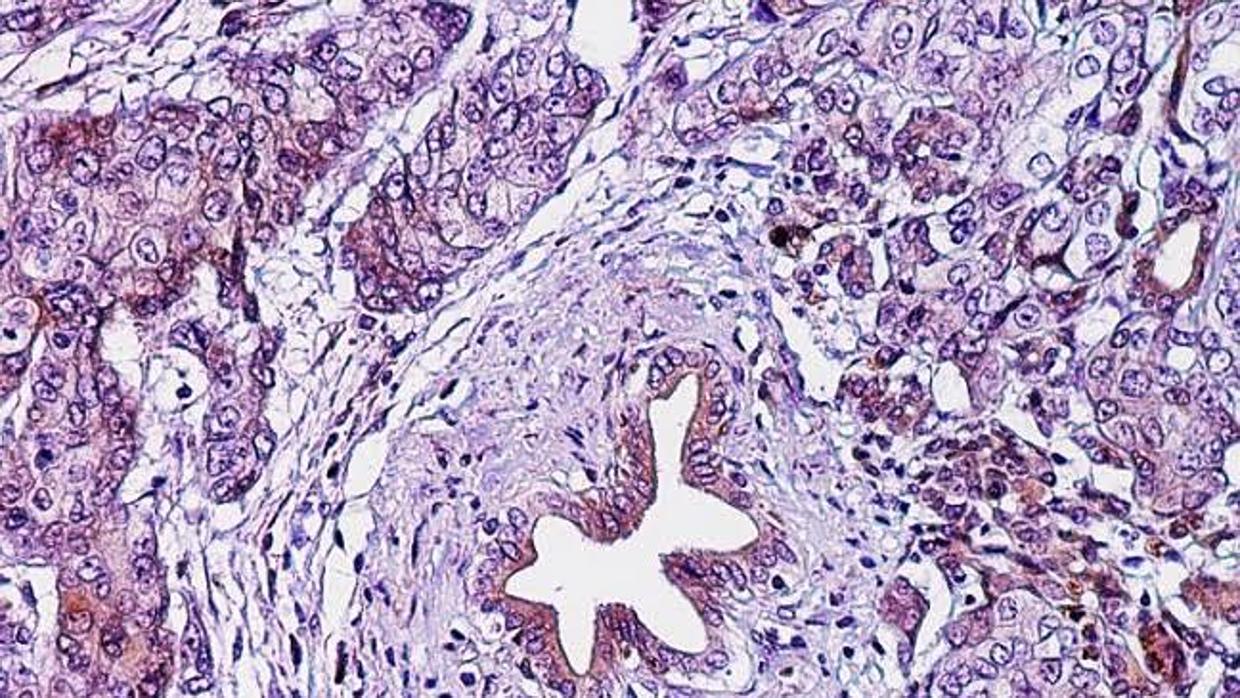 Adenocarcinoma ductal de páncreas