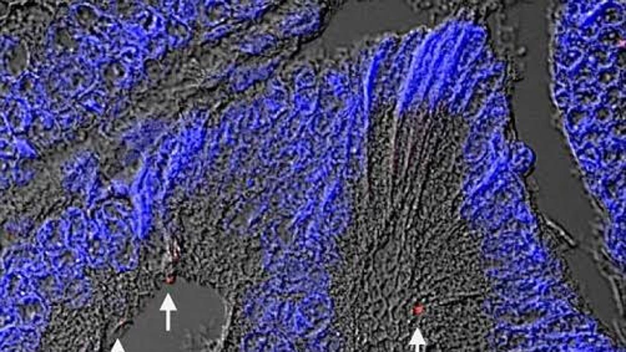 Detección de la bacteria en el tumor de un paciente con cáncer cololrrectal