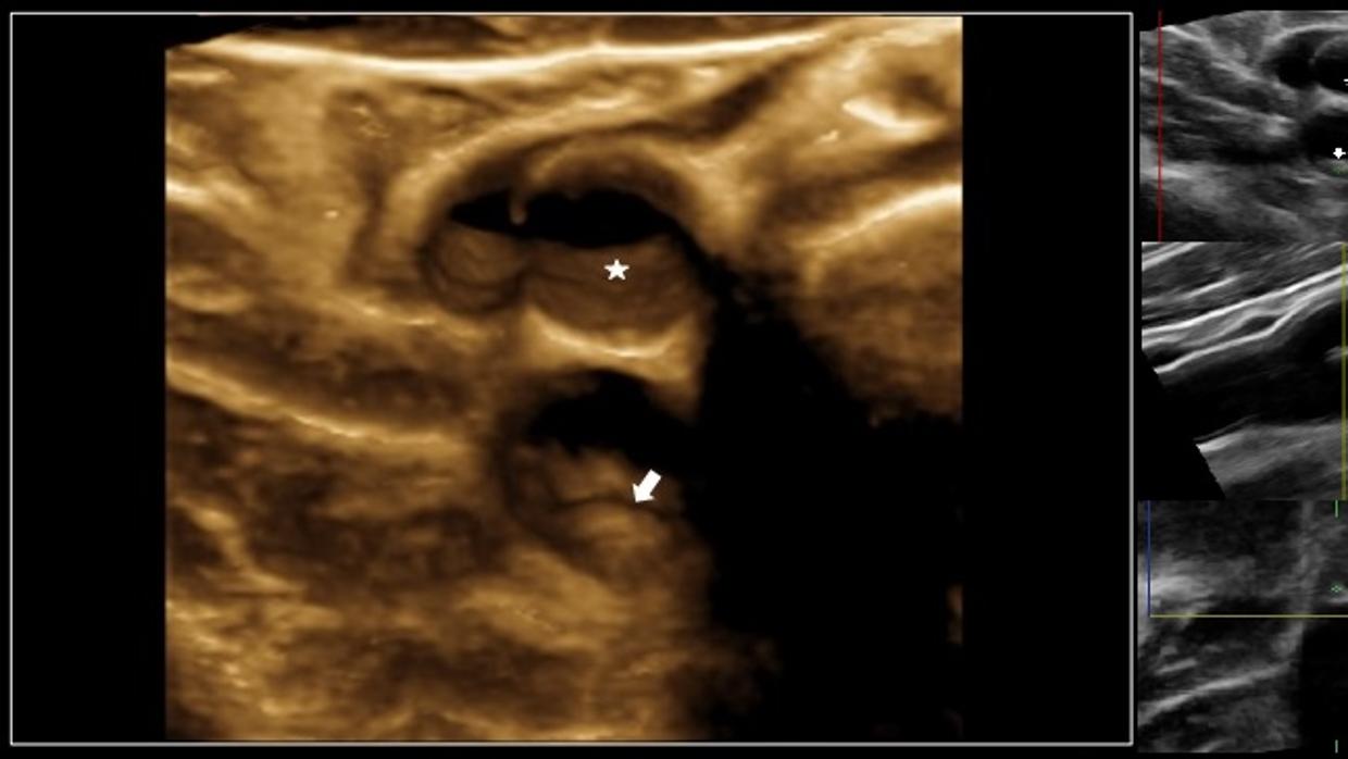 3D de la arteria carótida derecha donde se aprecia una pequeña protrusión en la pared del vaso que corresponde a una placa de aterosclerosis (flecha) en la rama inferior (interna) de la arteria carótida próxima a la zona del bulbo-bifurcación mientras que la rama superior (externa) está libre de enfermedad mostrando una superficie lisa (asterisco).