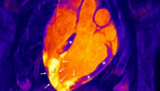 El corazón no se recupera como se pensaba tras un infarto