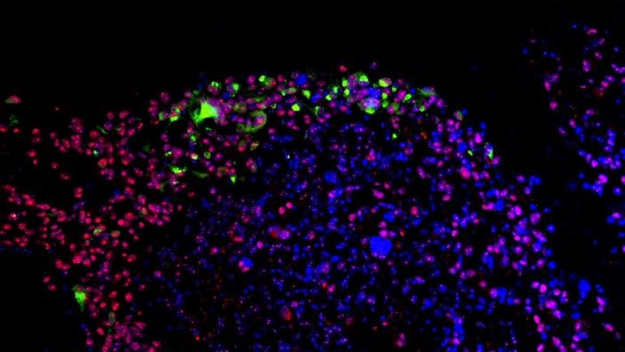 El virus del zika (en verde) actúa preferentemente sobre las células madre (en rojo) del glioblastoma