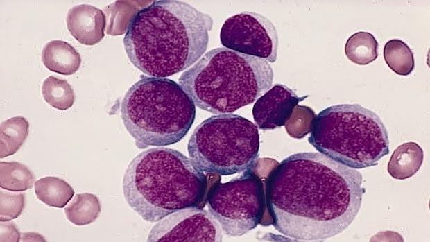 Identificadas las claves para prevenir la recurrencia de la leucemia mieloide aguda