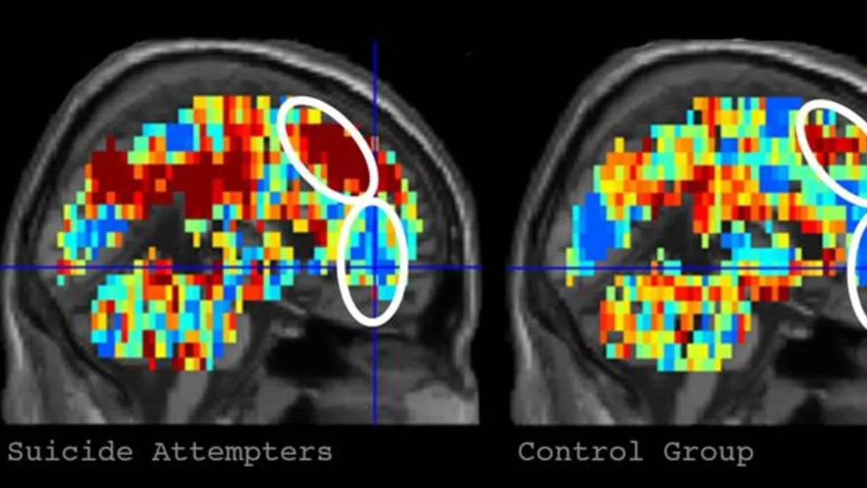 A la izquierda está el patrón de activación cerebral para "muerte" en participantes que hicieron un intento de suicidio. La imagen de la derecha muestra el patrón de activación de "muerte" en los participantes de control, mucho menos activado.