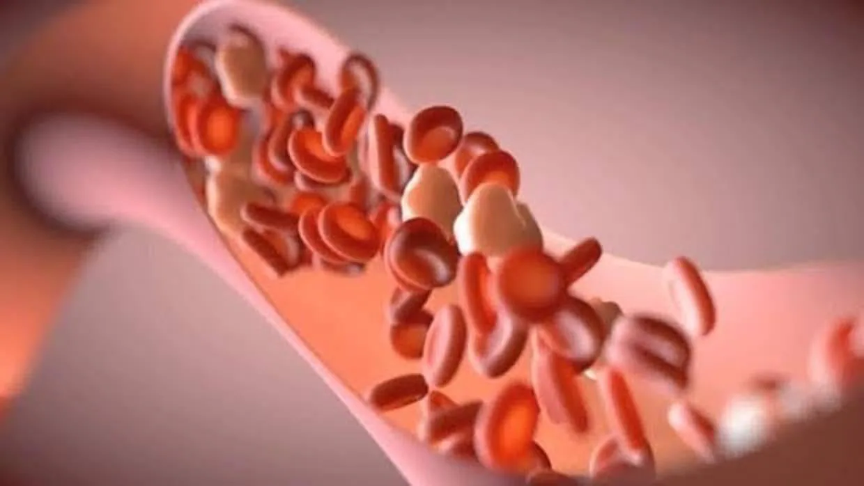 La aterosclerosis obstruye el lumen de los vasos sanguíneos