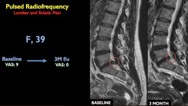 Diseñado un tratamiento capaz de curar el dolor lumbar crónico en solo 10 minutos