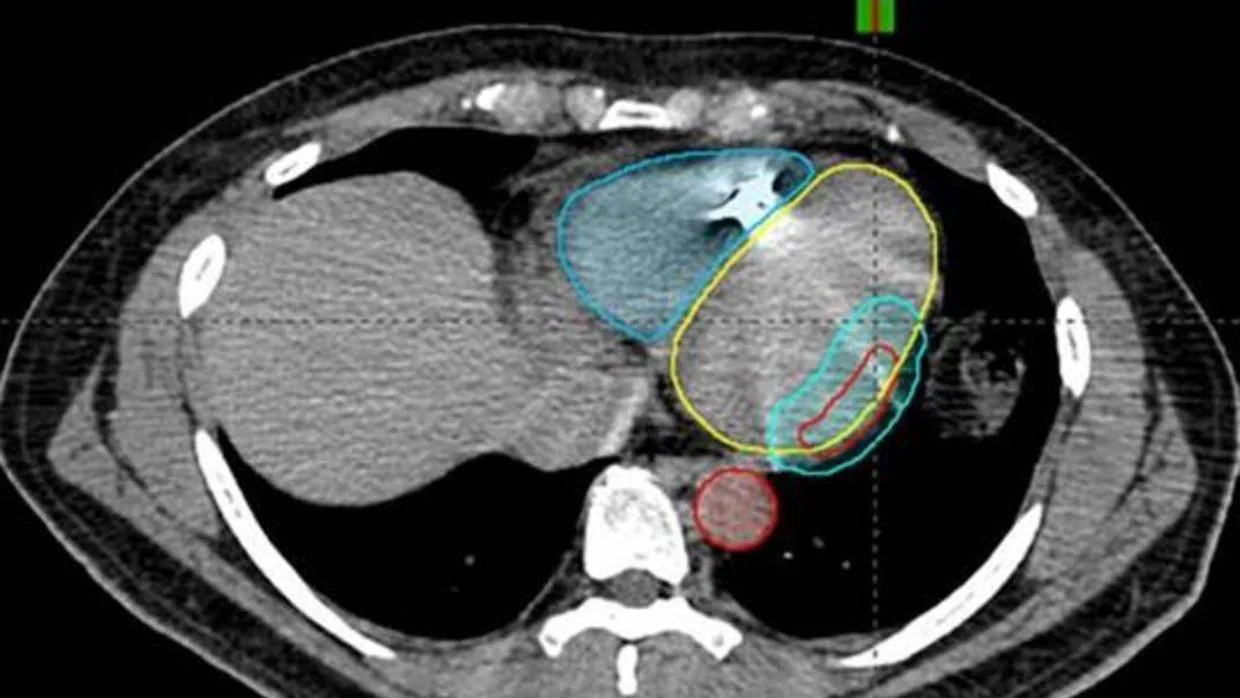 Área de irradiación en un paciente con taquicardia ventricular