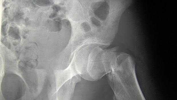 Los suplementos con calcio o vitamina D no previenen las fracturas por la osteoporosis