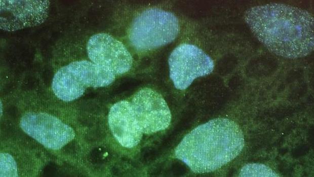 El trasplante de células madre aumenta la supervivencia de los pacientes con esclerodermia