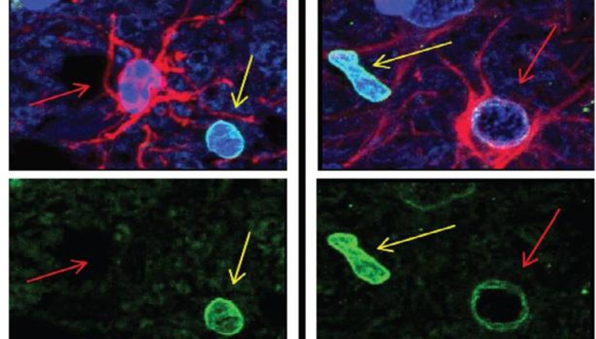 Muestras post-mortem de individuos con párkinson, las células cerebrales llamadas astrocitos muestran evidencia de senescencia celular. Las células senescentes pierden una proteína específica de sus núcleos; esta proteína está indicada con la señal verde en la imagen de arriba. Dicha proteína se pierde de los astrocitos (glóbulos rojos), pero no de las células vecinas. En la imagen de la izda., los astrocitos no parecen ser senescentes en individuos de control.