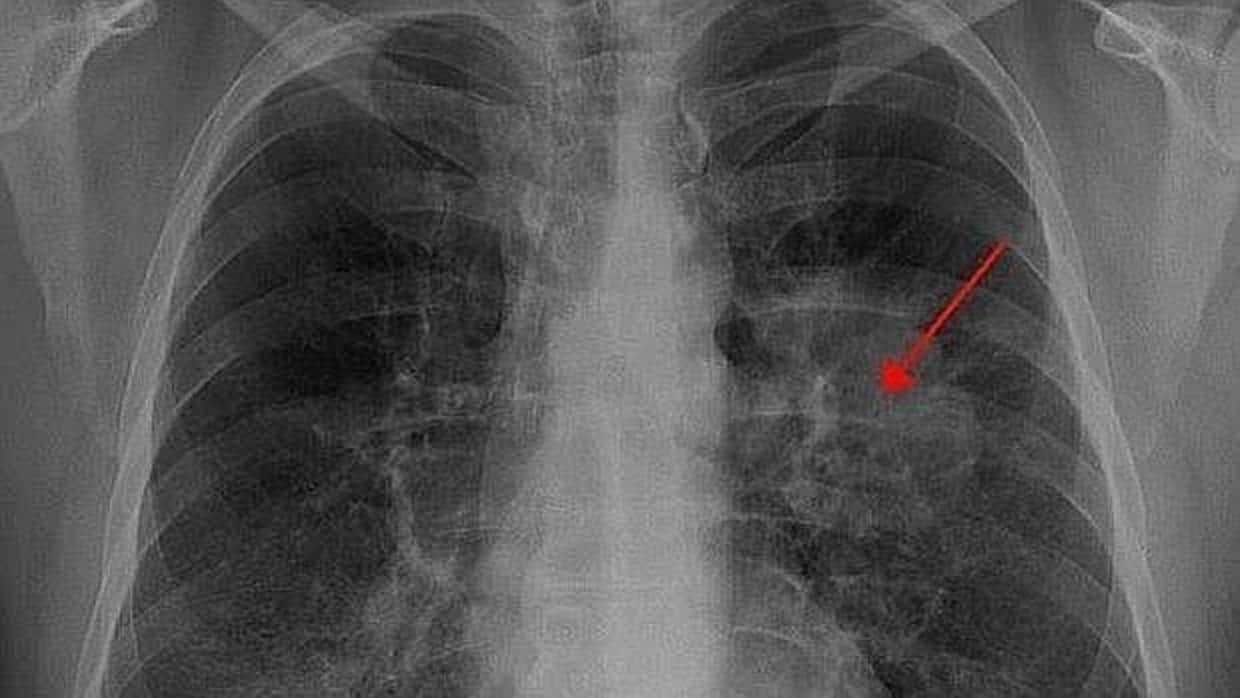 Radiografia de paciente con cáncer de pulmón