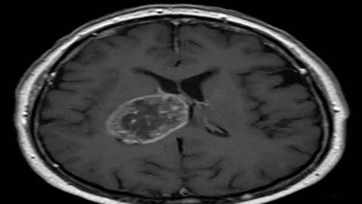 Glioblastoma en el cerebro de un paciente