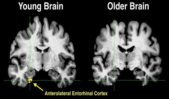 Prueba de imagen cerebral para la detección precoz del alzhéimer