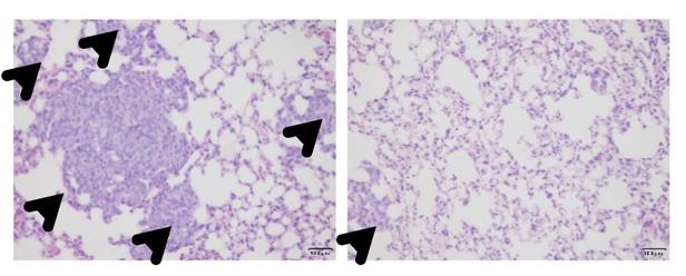 Hallado un fármaco capaz de prevenir las metástasis del cáncer de mama más letal