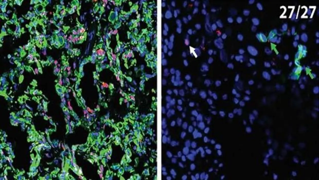 Las células cancerígenas expresan CK19 (en rojo) en el páncreas (izquierda) pero no en el hígado (derecha)