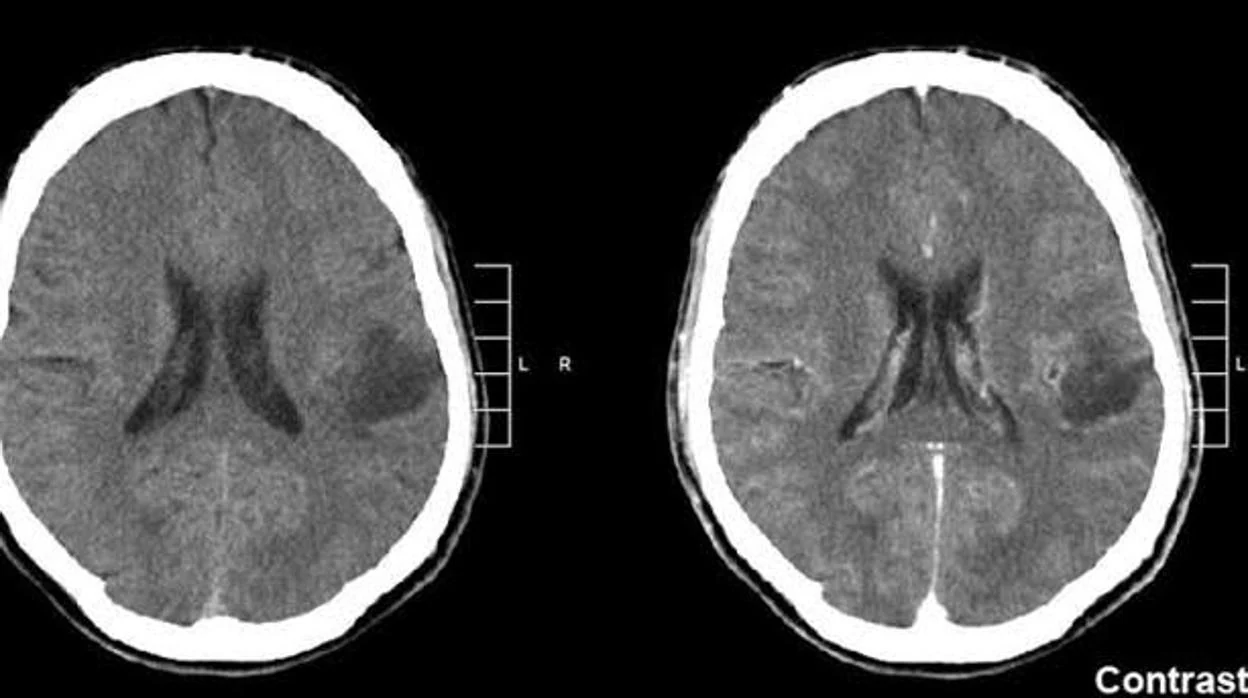 Imagen por resonancia magnética de un tumor cerebral
