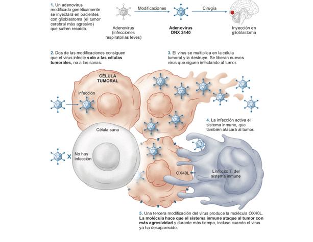 España probará un nuevo tratamiento que combina virus e inmunoterapia en tumores cerebrales