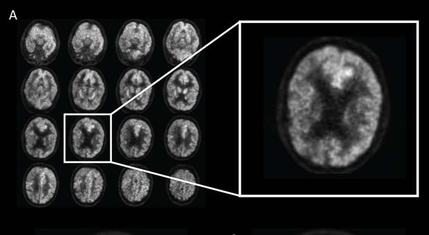 La inteligencia artificial detecta precozmente el alzhéimer