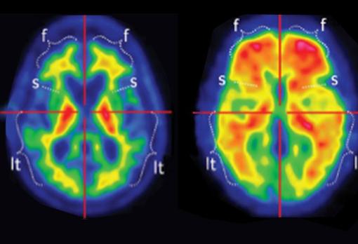 Cerebro con y sin placas de beta amiloide