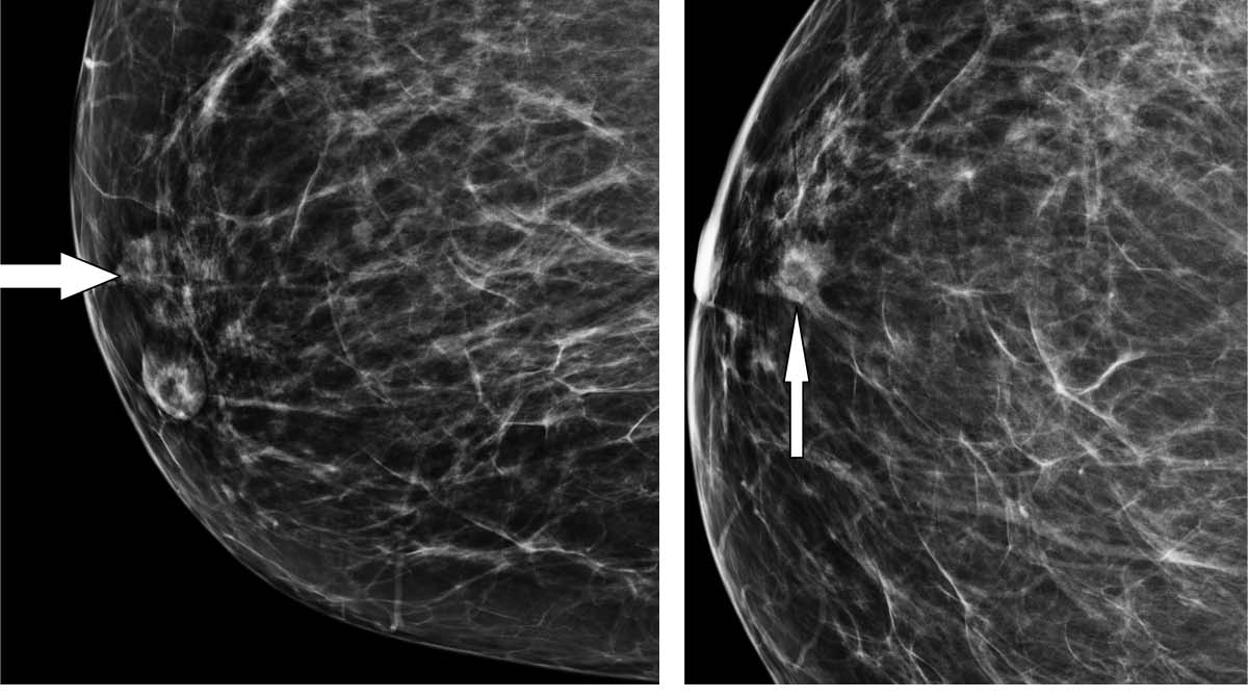 Una nueva técnica puede reducir significativamente las biopsias de mama