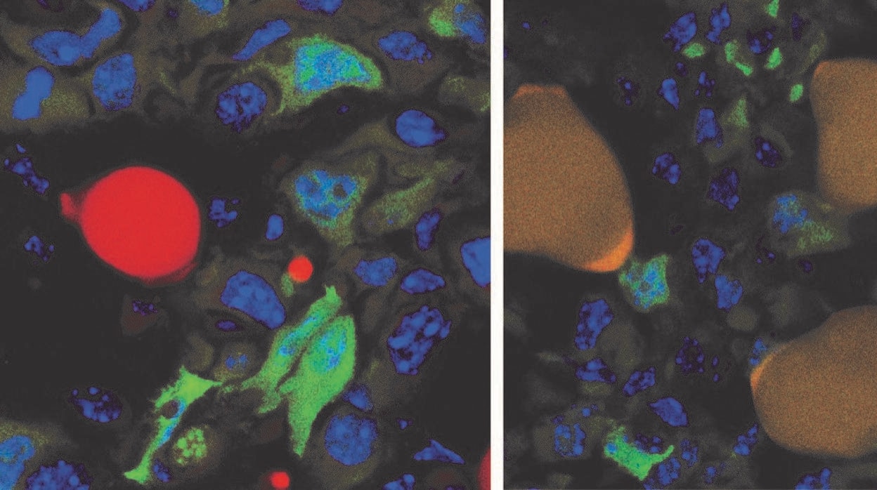 Las células cancerosas marcadas en verde y una célula grasa marcada en rojo en la superficie de un tumor (izquierda). Después del tratamiento (derecha), tres células cancerosas anteriores se han convertido en células grasas.
