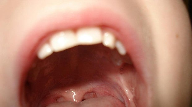 La lengua podría ayudar a detectar con cáncer de páncreas en etapa temprana