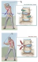 El swing de golf puede conducir a una degeneración lumbar temprana