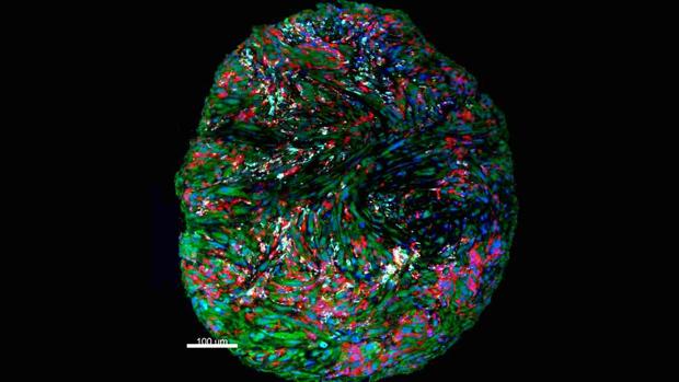 Dos estudios demuestran la eficacia de la inmunoterapia y cirugía en un cáncer cerebral maligno