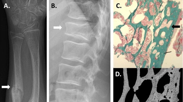 Osteoporosis, ¿una enfermedad hereditaria?