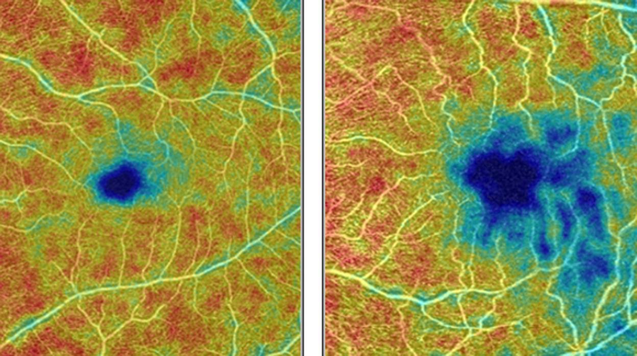 A la izquierda, la retina de una persona sana muestra una densa red de vasos sanguíneos, las áreas de mayor densidad resaltadas en rojo y naranja. A la derecha, la retina de una persona con enfermedad de Alzheimer muestra áreas en azul y verde azulado donde los vasos sanguíneos son menos densos.