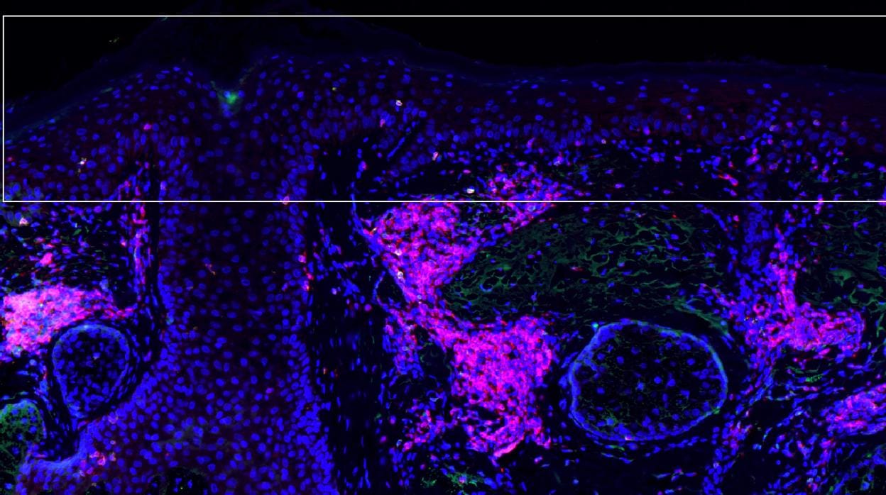 Células de queratosis actínicas precancerosas - células azules en el área encuadrada en la superficie de la piel - bajo ataque de células T (rosa) inducidas por el tratamiento con calcipotriol más 5-FU, que parecía reducir el riesgo de desarrollo posterior de carcinoma de células escamosas en un 75 por ciento .