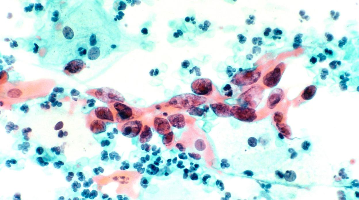 Carcinoma de células escamosas del cuello uterino