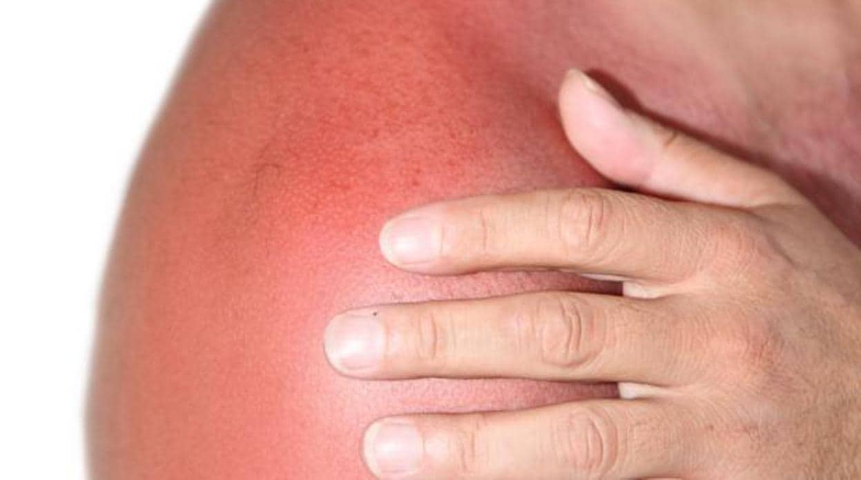 Las quemaduras solares incrementan el riesgo de cáncer de piel