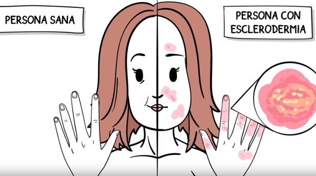 Diez consejos para personas con esclerodermia