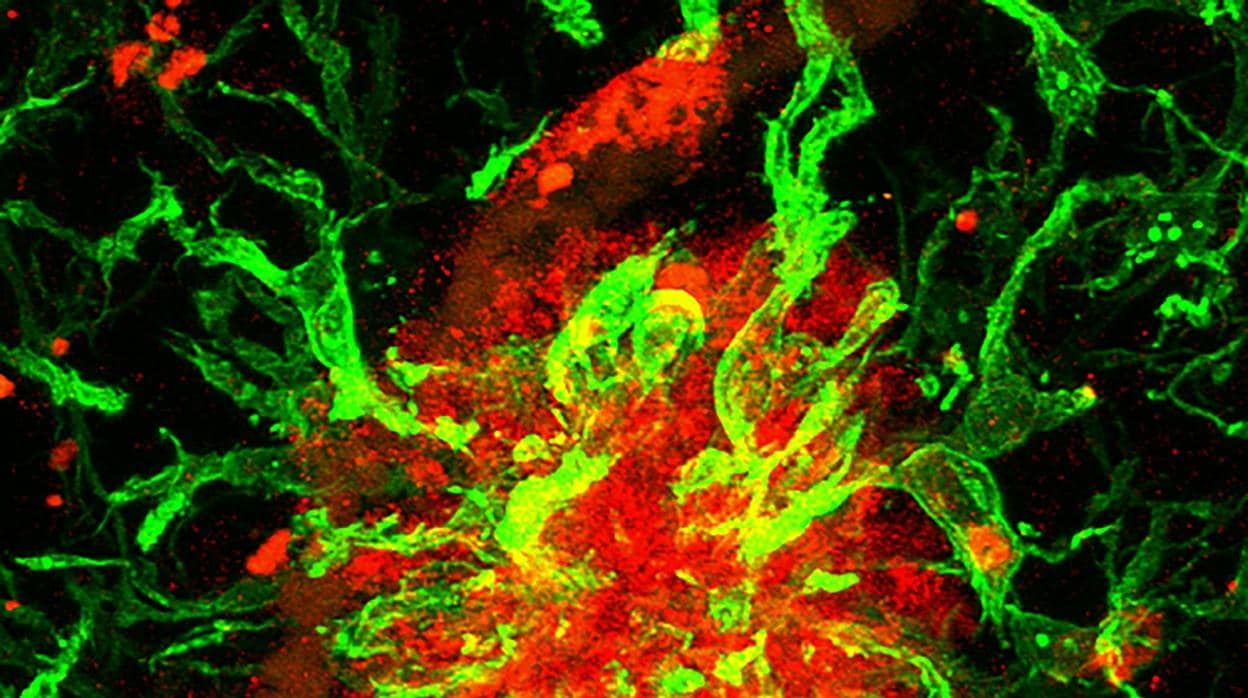 Ejemplo de placa amiloidea humana positiva para la proteína SFRP1 (rojo) y rodeada por células gliales (verde)