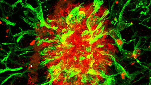 SFRP1, la proteína diana que desencadena la enfermedad de Alzheimer