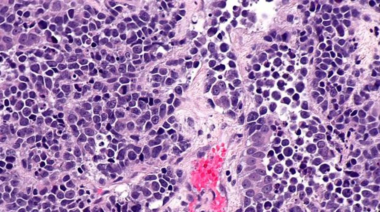 Carcinoma de vejiga