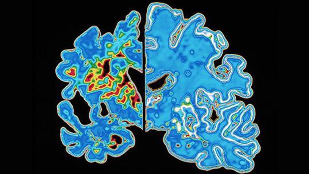 La anemia aumenta el riesgo de alzhéimer