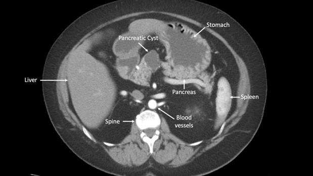 El trasplante fecal puede aumentar la supervivencia en pacientes con cáncer de páncreas