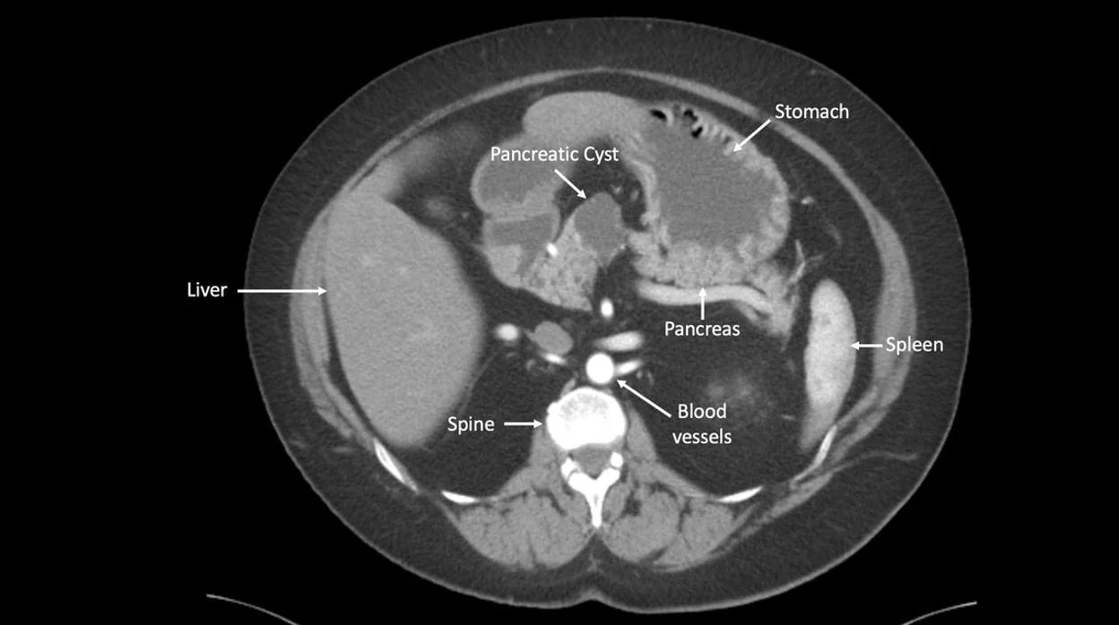 Imagen de un tumor en el páncreas