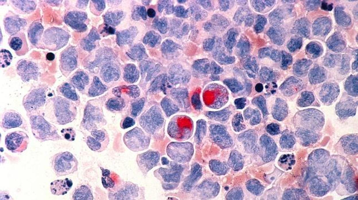Un grupo de investigadores españoles logra matar células madre leucémicas con antihistamínicos
