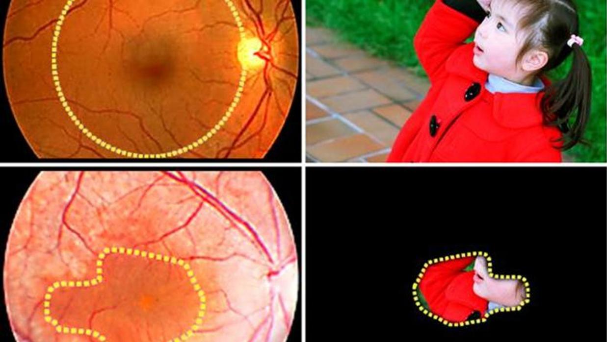 Uno de los síntomas de la retinosis pigmentaria es la visión en túnel