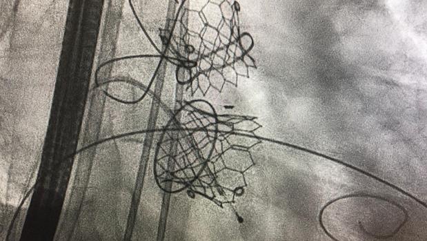 Primer doble implante valvular con catéter en España