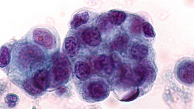 La clasificación del tumor de cáncer de páncreas podría optimizar las opciones de tratamiento