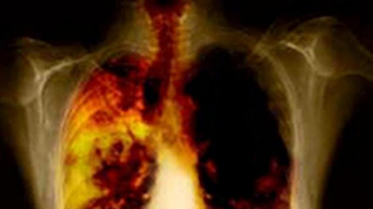 Imagen de unos pulmones enfermos