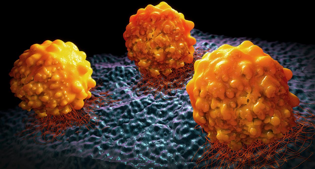 Eliminar la grasa de las células cancerosas evita la metástasis