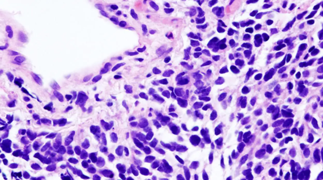 Células cáncer pulmón