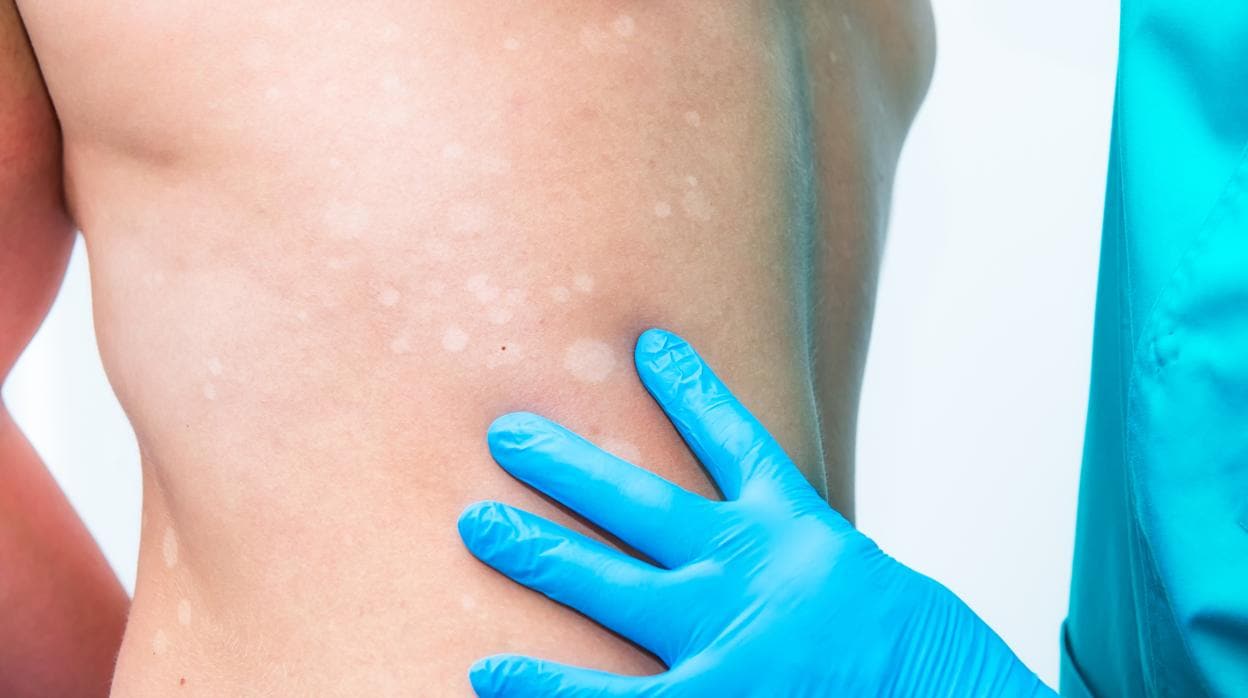 Todo lo que hay que saber sobre el vitíligo: La enfermedad que mancha la piel