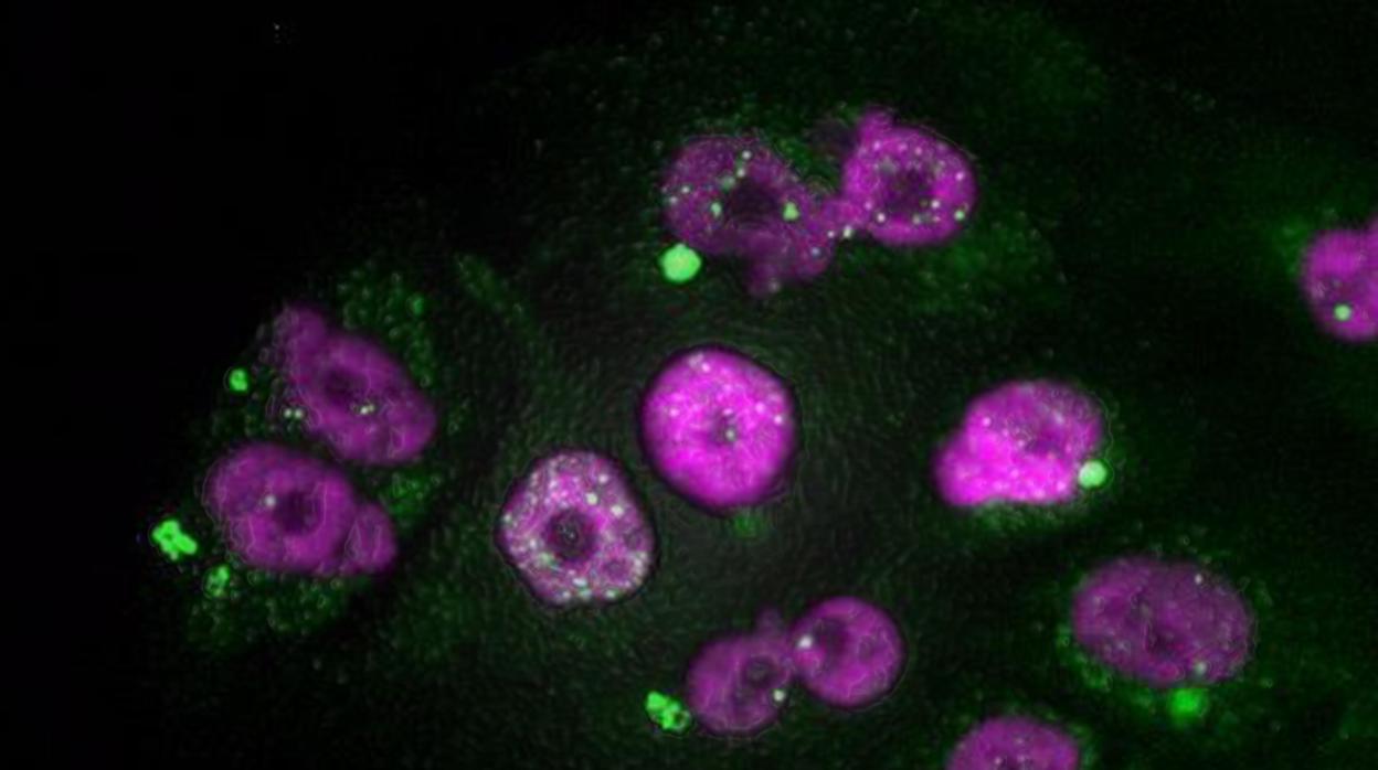 Células tumorales de adenocarcinoma de páncreas que muestran signos de daño en el ADN del núcleo (puntos blancos) y de micronúcleos (en verde), después de un tratamiento con taxol seguido de inhibidores de CDK4/6